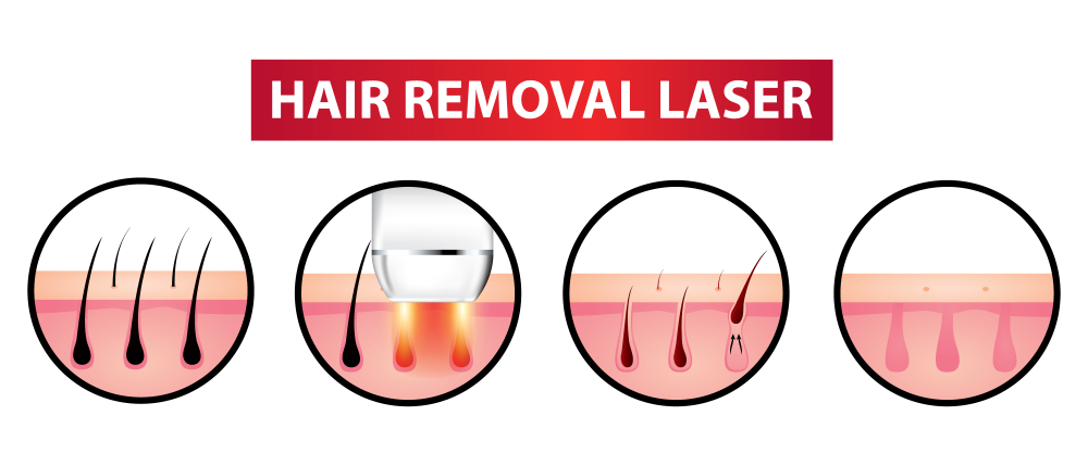 Removing-Hair-via-Laser-Treatment
